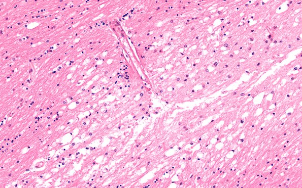 2C6 Embolism, air (Case 2) N11 H&E 20X 2