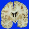 10A1  Infarcts, multiple, thromboembolic (Case 10) 4