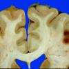 10A2  Infarcts, multiple, thromboembolic (Case 10) 3