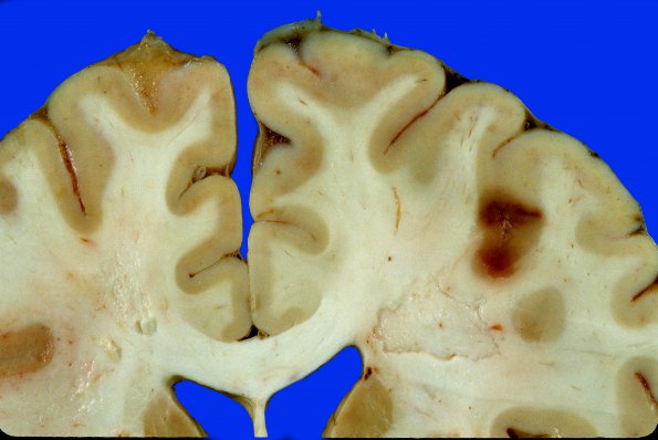 10A2  Infarcts, multiple, thromboembolic (Case 10) 3