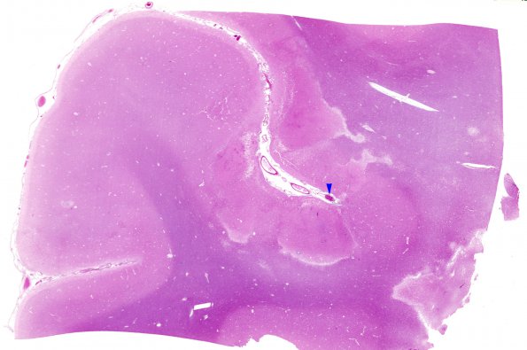 10B1  Infarct, Embolic  (Case 10) b copy