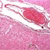 10B2 Infarct, Embolic  (Case 10)  c