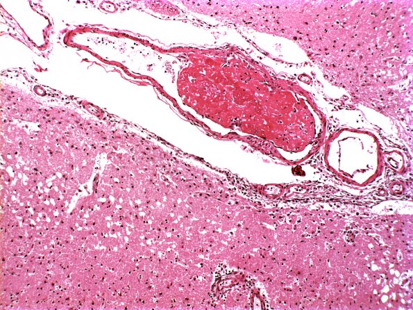 10B2 Infarct, Embolic  (Case 10)  c