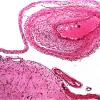 10B3  Infarct, Embolic  (Case 10) a