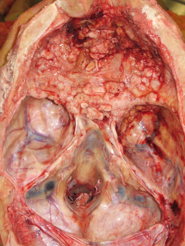 11A1 Infarct, embolic, Adenoid Cystic CA (Case 11) gross 1