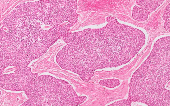 11A2 Infarct, embolic, Adenoid Cystic CA (Case 11) ND H&E