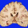 11B1 Infarct, embolic, Adenoid Cystic CA (Case 11) gross 6