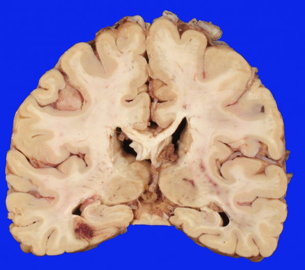 11B1 Infarct, embolic, Adenoid Cystic CA (Case 11) gross 6