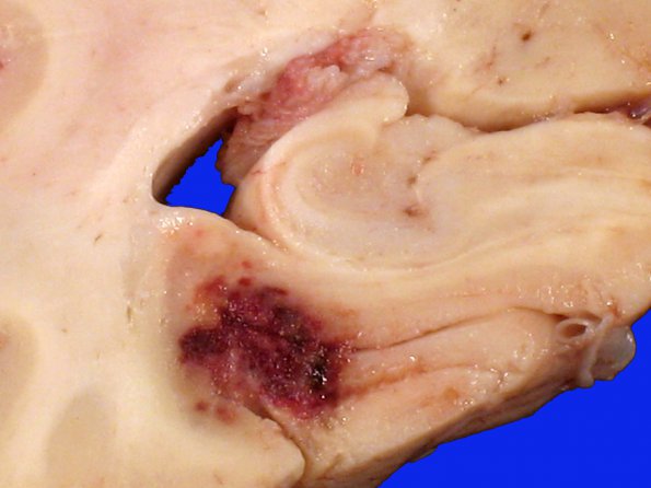 11B2 Infarct, embolic, Adenoid Cystic CA (Case 11) gross 8