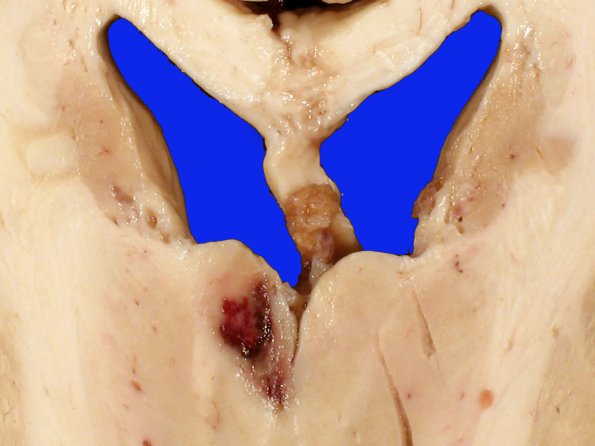 11B3 Infarct, embolic, Adenoid Cystic CA (Case 11) gross 7