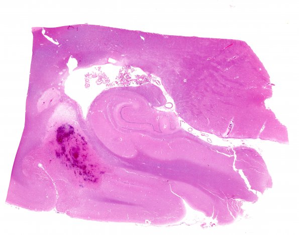 11C1 Infarct, embolic, Adenoid Cystic CA (Case 11) H&E WM