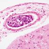 11C2 Infarct, embolic, Adenoid Cystic CA (Case 11) H&E 1