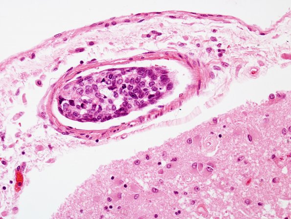 11C2 Infarct, embolic, Adenoid Cystic CA (Case 11) H&E 1