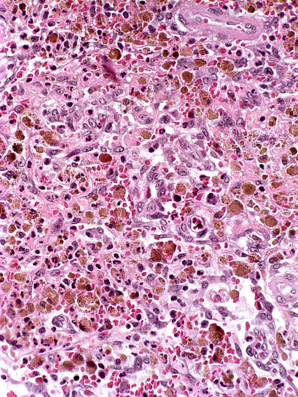 12A1 Infarct, Embolic, Atrial Myxoma (Case 12) e