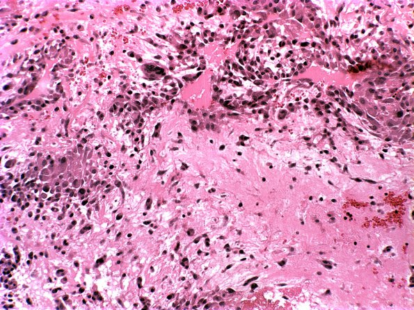 12A2 Infarct, Embolic, Atrial Myxoma (Case 12) a