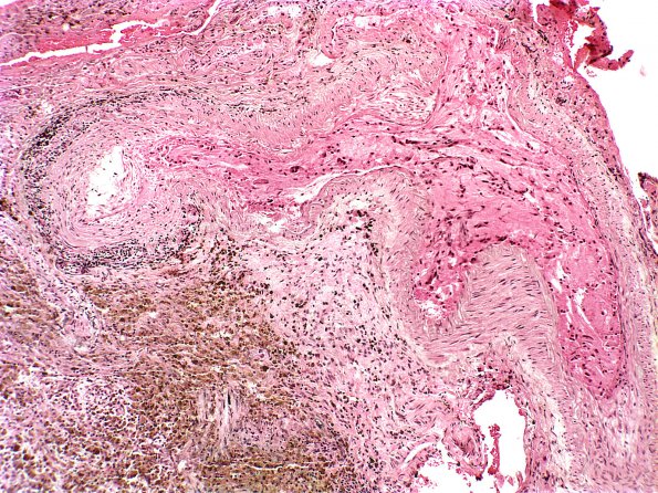 12A3 Infarct, Embolic, Atrial Myxoma (Case 12)  a