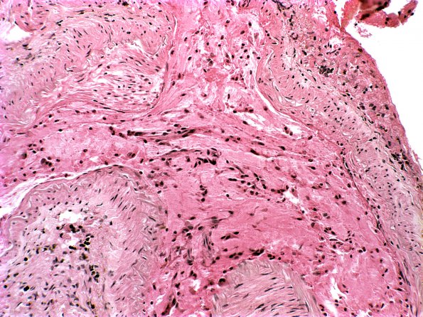 12A4 Infarct, Embolic, Atrial Myxoma (Case 12) b