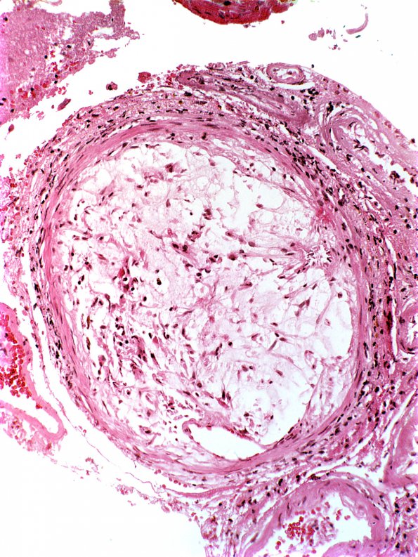 12A5 Infarct, Embolic, Atrial Myxoma (Case 12) d