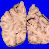 13A1 Infarct, embolic, heart valve origin (Case 13) A_3