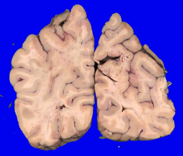 13A1 Infarct, embolic, heart valve origin (Case 13) A_3