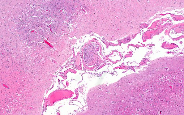 13B2 Infarct, embolic, heart valve origin (Case 13) H&E 11