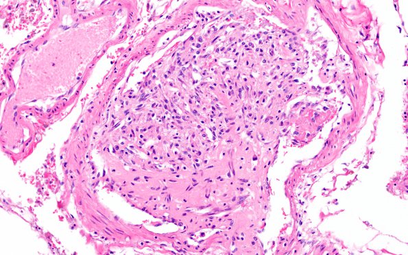 13B3 Infarct, embolic, heart valve origin (Case 13) H&E 12