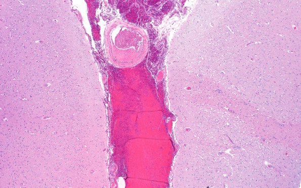 13B4 Infarct, embolic (Case 13) N12 H&E 4X 2