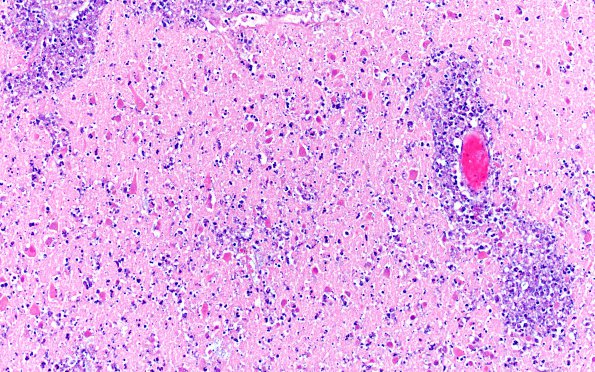 13B7 Infarct, embolic, heart valve origin (Case 13) H&E 20