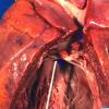 13C Infarct, embolic, heart valve origin (Case 13) _2 copy