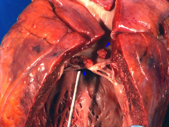 13C Infarct, embolic, heart valve origin (Case 13) _2 copy