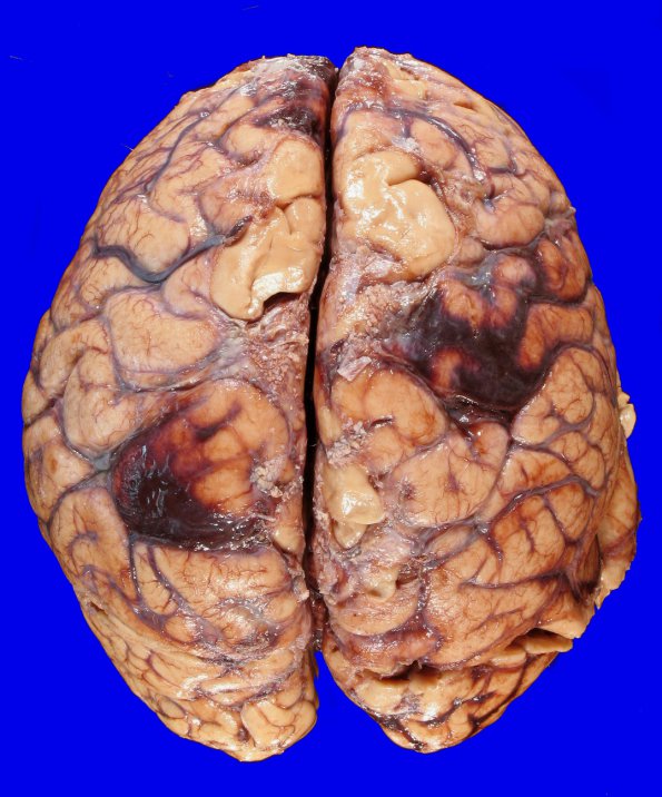 14A1 Infarct, Embolic, SBE (Case 14) _1