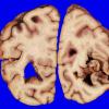 14A2 Infarct, Embolic, SBE (Case 14) _5