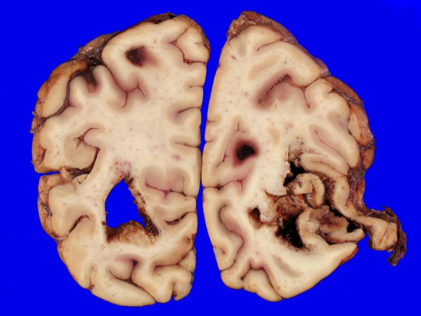 14A2 Infarct, Embolic, SBE (Case 14) _5