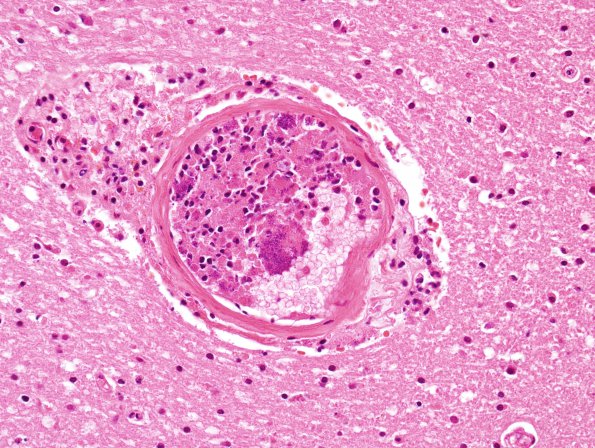 14B2 Infarct, Embolic, SBE (Case 14) 1