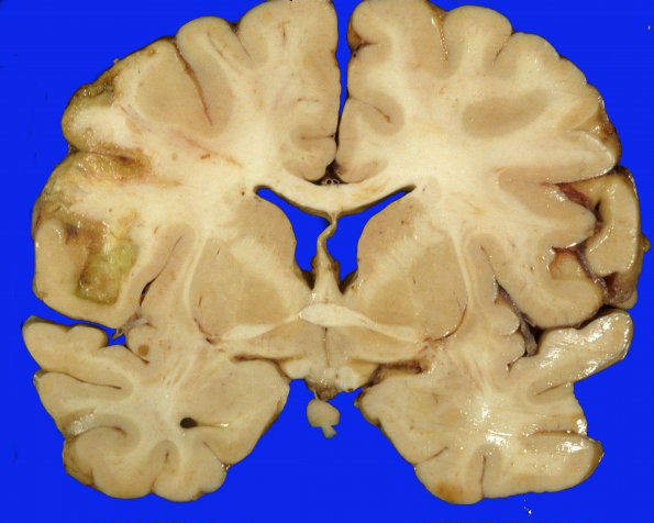 15A1  Embolism, septic, endocarditis (Case 15) 2 (2)