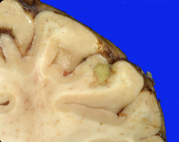 15A2 Embolism, septic, endocarditis (Case 15) 1 (2)