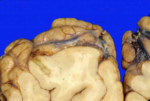 15A3 Embolism, septic, endocarditis (Case 15) 3 (2)