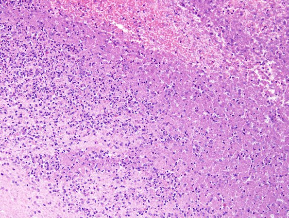 15B2 Infarct, embolic, septic (Case 15) H&E 3