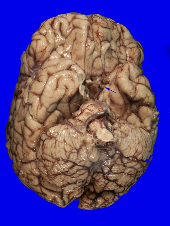 16A1 Infarction, recent, embolic (Case 16)