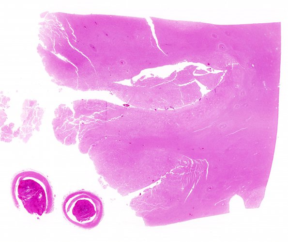 16B1 Infarction, recent, likely embolic (Case 16) N11