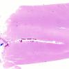 16B2  Infarction, recent, likely embolic (Case 16)  N1 copy