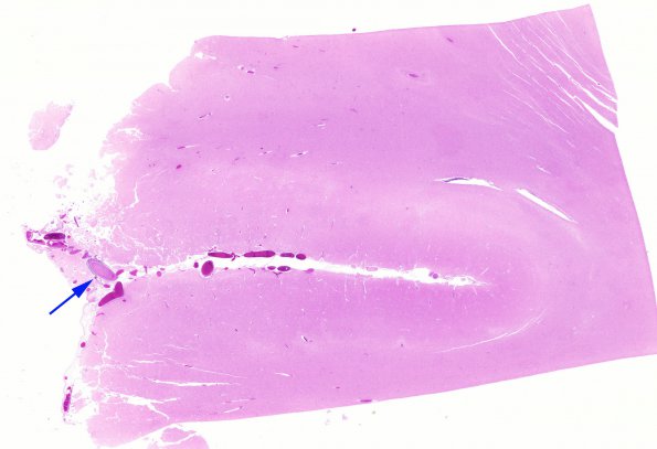 16B2  Infarction, recent, likely embolic (Case 16)  N1 copy