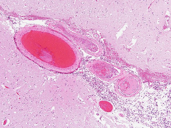 16B6 Infarct, recent, likely embolic (Case 16) H&E 15
