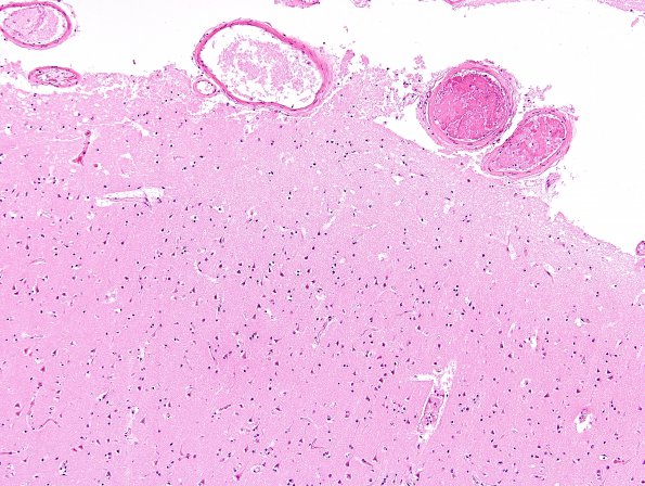 16B8 Infarct, recent, likely embolic (Case 16) H&E 1