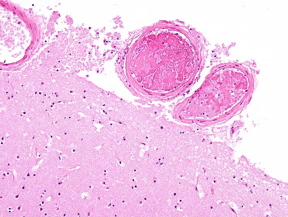 16B9 Infarct, recent, likely embolic (Case 16) H&E 2