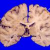 17A1 Infarcts, embolic, SBE (Case 17) 2 copy