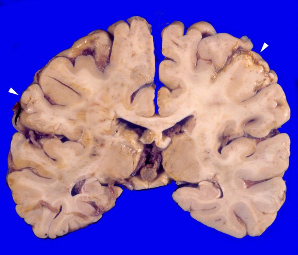 17A1 Infarcts, embolic, SBE (Case 17) 2 copy