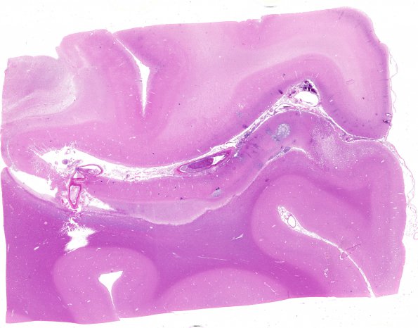 17B1 Infarcts, embolic, SBE (Case 17) N5 H&E WM