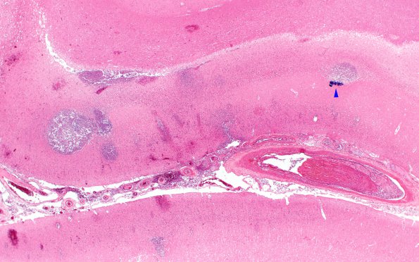 17B2 Infarcts, embolic, SBE (Case 17) N5 H&E 2X copy