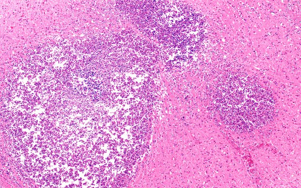 17B3 Infarcts, embolic, SBE (Case 17) N5 H&E 2